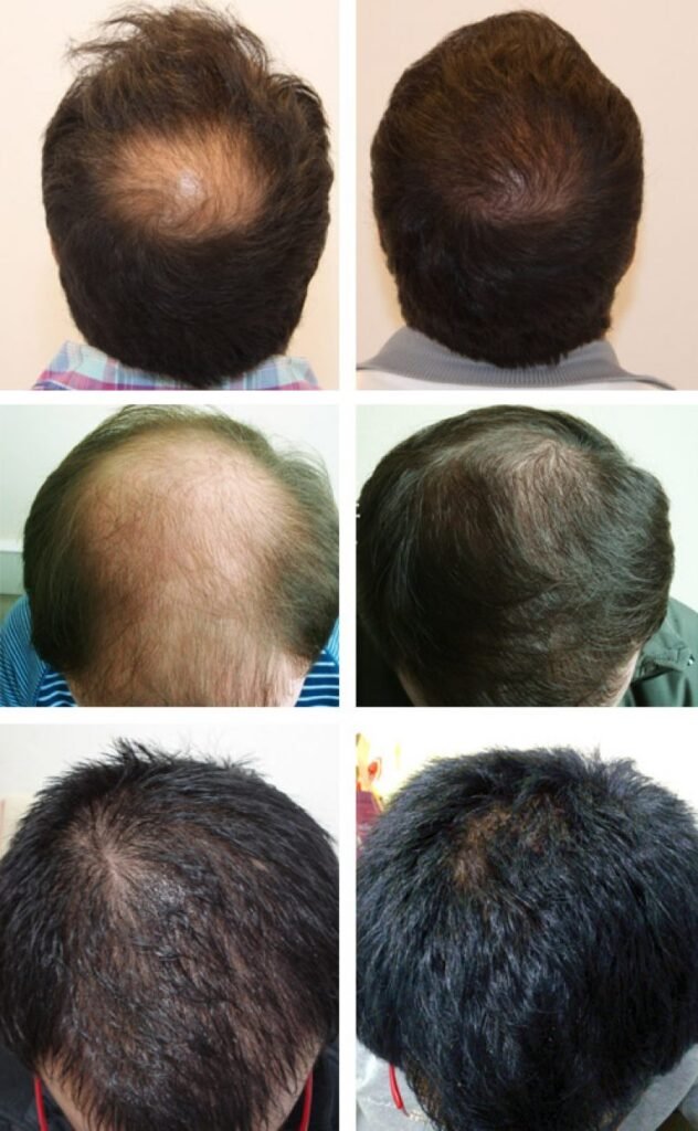 HAIR TRANSPLANT TECHNICIAN TRAINING